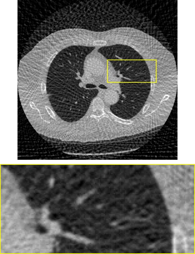 CT: Filtered backprojection